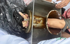 Bị máy xay thịt cuốn tay, nam công nhân bị cắt cụt tới 1/3 trên cẳng tay