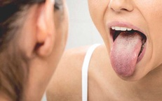 Bị ung thư lưỡi di căn hạch do chủ quan từ vết loét nhỏ