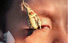 Suýt mù mắt khi đi câu cá, cảnh báo tai nạn nghiêm trọng