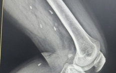 
Phát hiện nhiều kén sán ở chân bệnh nhân do một thói quen thường gặp