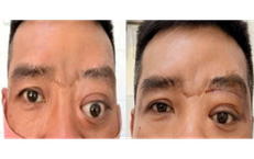 Bệnh hiếm gây lồi mắt, 20 năm Bệnh viện Tai Mũi Họng TPHCM chỉ gặp 2 ca