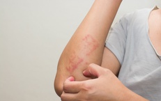 Viêm da dị ứng kiêng gì?