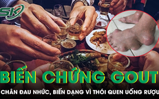 Bàn chân biến dạng, đau nhức dữ dội vì thói quen của nhiều đàn ông Việt