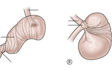 Xoắn dạ dày ở trẻ em rất nguy hiểm, cha mẹ cần phát hiện sớm