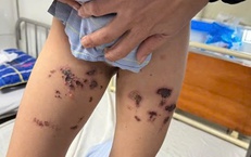 Bé trai bỏng nặng tầng sinh môn do nước tẩy bồn cầu bắn vào người