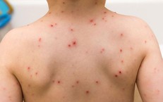 3 bệnh thường gặp ở trẻ vào mùa xuân