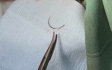 Kim khâu 'mắc kẹt' 11 năm ở tầng sinh môn của bệnh nhân