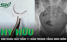 Kim khâu gãy bị bỏ sót, nằm 11 năm trong tầng sinh môn người phụ nữ
