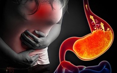 Biến chứng nguy hiểm của bệnh trào ngược dạ dày thực quản