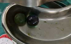 Nhiều trẻ nhỏ bị tắc ruột do nuốt hạt nở đồ chơi