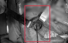 Nấm đen 'ăn' mòn xoang hàm người đàn ông khỏe mạnh