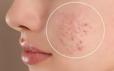 Mùa đông ảnh hưởng như thế nào đến da mụn và cách chăm sóc da đúng cách