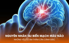 Nguyên nhân tai biến mạch máu não: Những yếu tố âm thầm cần cảnh giác