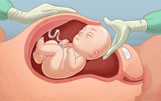 Yếu tố hình thành nhau cài răng lược - mối nguy hiểm trong thai kỳ