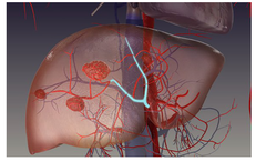 Đau tức hạ sườn, ăn kém, sút cân… cảnh giác với u máu gan