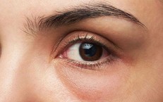 Cách giảm bọng mắt với động tác yoga mặt chỉ 4 phút mỗi ngày