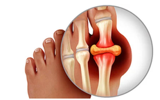 Bị gout tái đi tái lại, chữa thế nào?