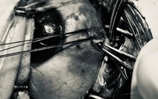 Bảo tồn nhãn cầu cho bệnh nhân bị đinh sắt bắn vào mắt