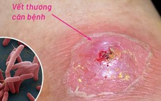 Hai bệnh nhân nguy kịch vì Whitmore, cảnh báo nguy cơ sau mưa lũ