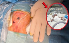 Bé trai sinh non 700 gram thủng ruột tự phát đặc biệt nguy kịch