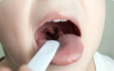 Viêm mũi họng kéo dài ảnh hưởng gì đến sức khỏe trẻ?