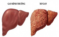 Dấu hiệu cảnh báo xơ gan không thể bỏ qua
