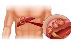 6 nhóm người có nguy cơ cao mắc xơ gan