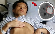 Người đàn ông đang khỏe mạnh bất ngờ đột quỵ, dấu hiệu nhiều người Việt bỏ qua