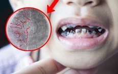 Tự nhổ răng sâu, bé trai 10 tuổi xuất huyết não nghiêm trọng