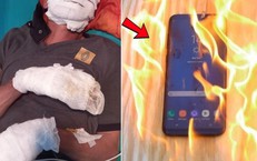 Bỏng nặng suýt mất tay vì dùng điện thoại khi đang sạc