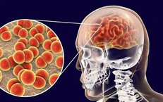 Sau chùm ca bệnh nhiễm não mô cầu tại trường học ở TP. HCM, Bộ Y tế khuyến cáo gì?