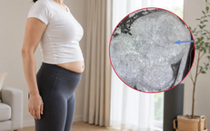 Bụng to bất thường, người phụ nữ 40 tuổi phát hiện 25 khối u xơ tử cung