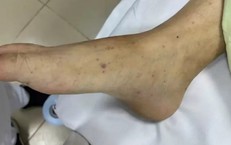 Bệnh do não mô cầu có tỷ lệ mắc thấp, tại sao vẫn xảy ra bùng phát?