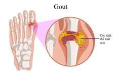 Vì sao người trẻ có thể mắc gout?