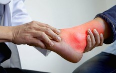 Bệnh gout không chỉ do ăn uống