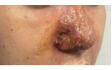 Mũi đầy mủ sau tiêm filler ở spa, bác sĩ cảnh báo biến chứng nguy hiểm