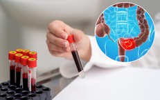 Ung thư đại trực tràng ngày càng trẻ hóa: Những dấu hiệu cảnh báo sớm