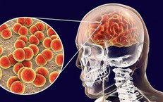 Bệnh não mô cầu nguy hiểm thế nào, phòng bệnh ra sao?