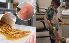 Bé 3 tuổi bị nước mì nóng đổ vào người, mẹ cứu con nhờ làm việc này