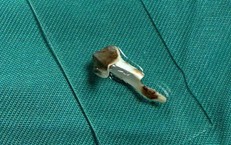 Bé 13 tuổi ho kéo dài hơn 3 năm, bác sĩ phát hiện dị vật nhựa trong phế quản