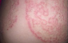 5 nguyên tắc quan trọng giúp phòng ngừa nấm da