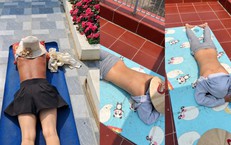 Sau 'chanh liều cao' lại xuất hiện hội 'thích phơi nắng': Cẩn thận ung thư da
