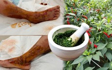 Người phụ nữ 65 tuổi hoại tử chân sau khi đắp lá ớt chữa vết thương