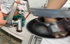 Nữ đầu bếp gặp tai nạn kinh hoàng khi xay thịt phải cắt bỏ 3 ngón tay