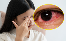 Mắt trái sưng đỏ kèm đau đầu, bác sĩ phát hiện nguyên nhân ít ai ngờ