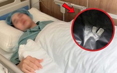 Cấy đá dương vật để tăng khoái cảm và cầu con, người đàn ông nhận kết đắng