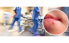 Tự nặn mụn trên mũi, nam thanh niên sốt cao, mặt sưng biến dạng vì biến chứng