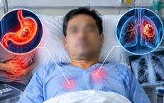Tưởng đau dạ dày, người đàn ông bất ngờ mắc ung thư phổi giai đoạn cuối