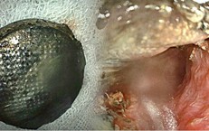 Trẻ bị tổn thương nghiêm trọng thực quản vì pin cúc áo, bác sĩ khuyến cáo