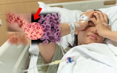 Đau họng uống thuốc mãi không khỏi, đi khám bất ngờ phát hiện mắc bệnh lậu
